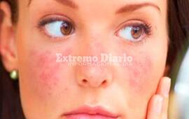 Imagen de D&iacute;a Mundial del Lupus: m&aacute;s de 5 millones de personas conviven a diario con esta enfermedad