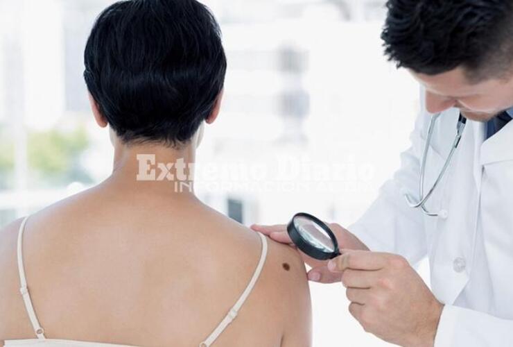 Imagen de Día Mundial del Melanoma: Controlar lunares puede ser la principal medida de prevención de este tipo de cáncer de piel