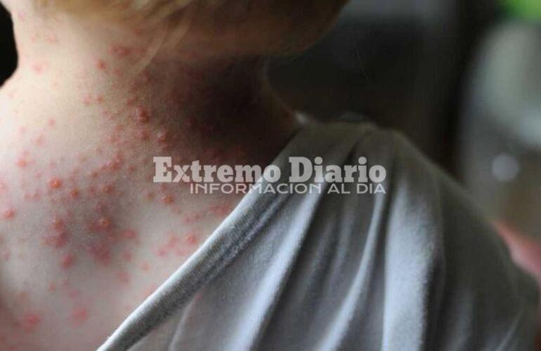 Imagen de Confirmaron el tercer caso de viruela del mono en el pa&iacute;s