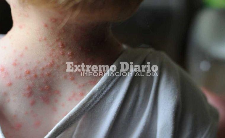 Imagen de Confirmaron el tercer caso de viruela del mono en el pa&iacute;s