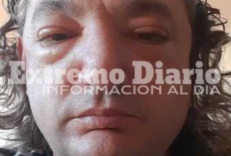 Imagen de Triquinosis: &iquest;C&oacute;mo es la vida despu&eacute;s de la enfermedad?