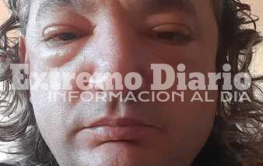 Imagen de Triquinosis: &iquest;C&oacute;mo es la vida despu&eacute;s de la enfermedad?