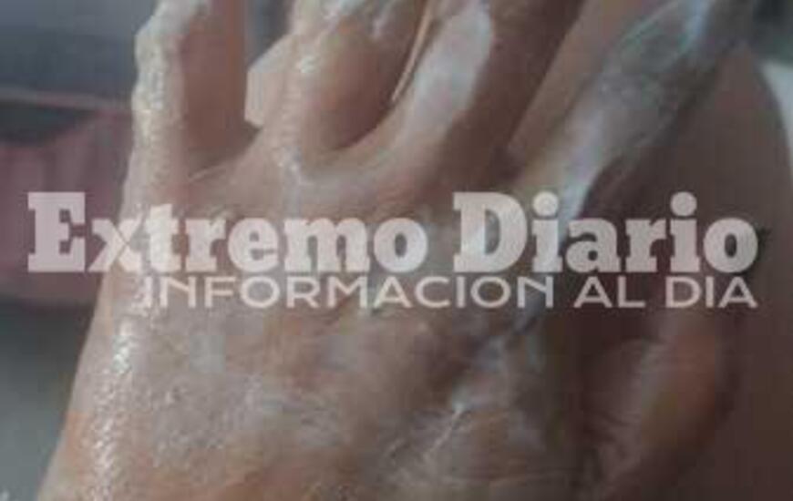 Imagen de Una mujer result&oacute; herida luego de una explosi&oacute;n en el horno de su casa