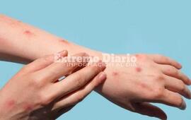 Imagen de Confirmaron la primera muerte por viruela s&iacute;mica en Argentina