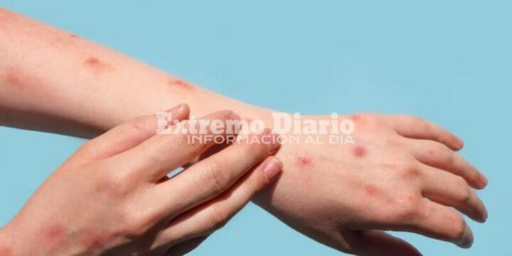 Imagen de Confirmaron la primera muerte por viruela símica en Argentina