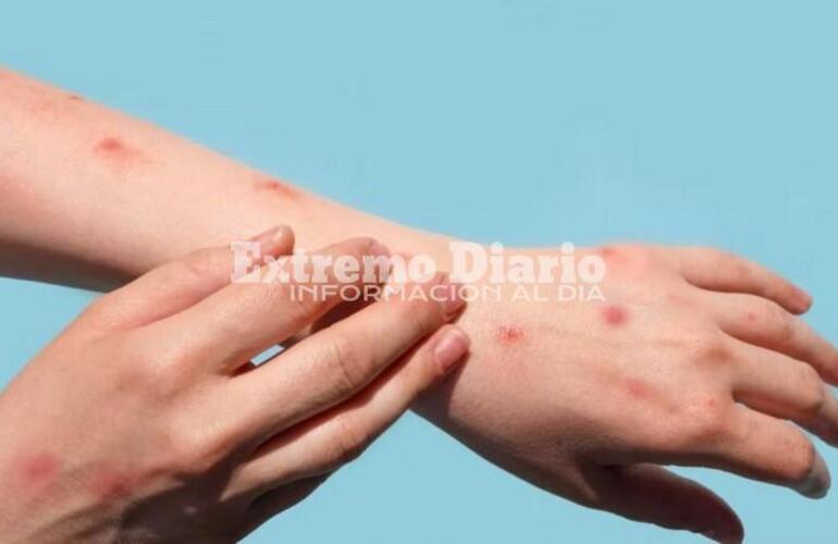 Imagen de Confirmaron la primera muerte por viruela símica en Argentina